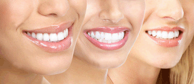 Как проходит процедура отбеливания зубов